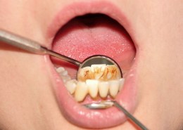 Can gingivitis be prevented?