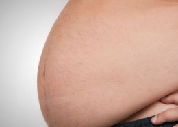 Is Obesity Hereditary, what are the causes of Obesity?
